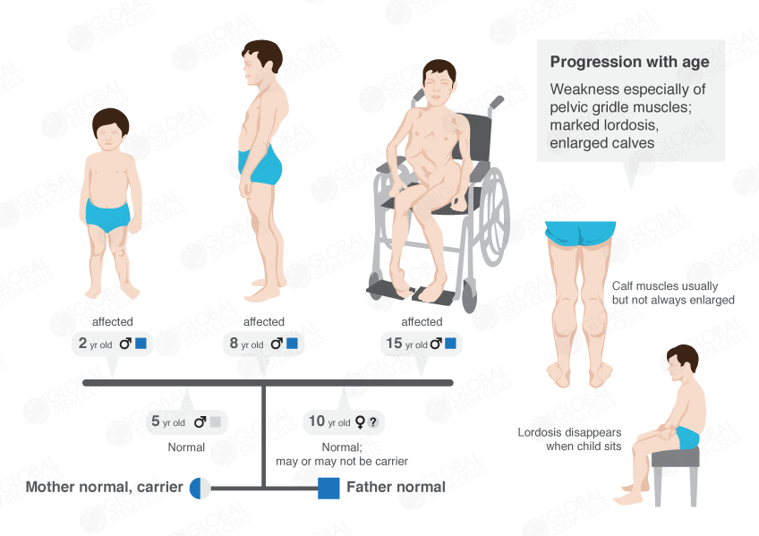 What are the different types of muscular dystrophy?