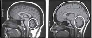 MRI improvement in an Ataxia patient treated with stem cells.