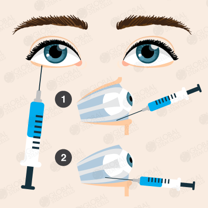 Global Stem Cells - ONH / SOD