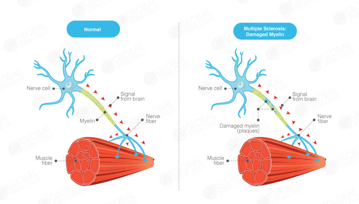 Multiple Sclerosis (MS) - Find the Best Stem Cell ...