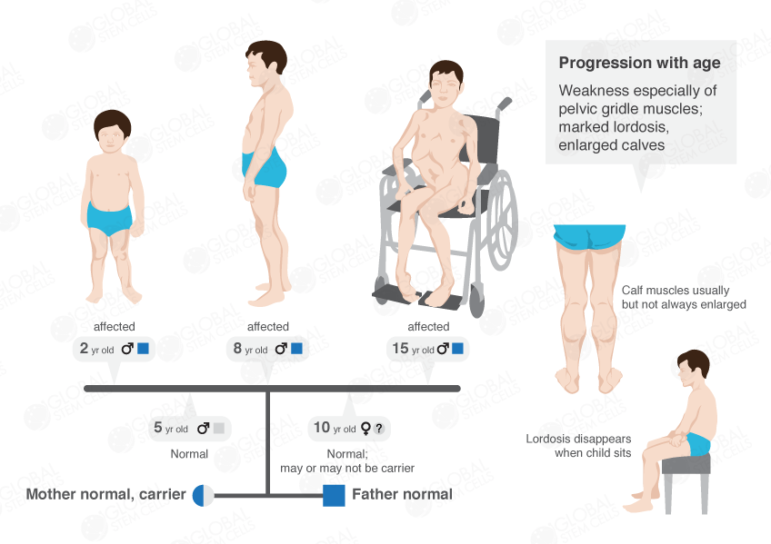 Global Stem Cells - Muscular Dystrophy Improvements