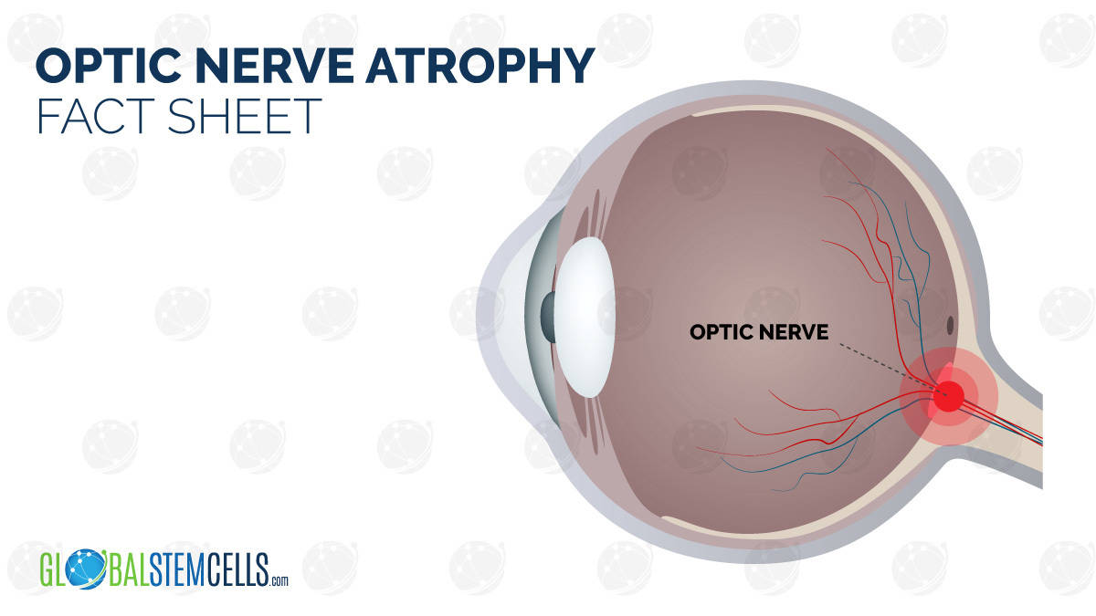 Patient s Improvements After Treatment For Optic Nerve Atrophy GSC