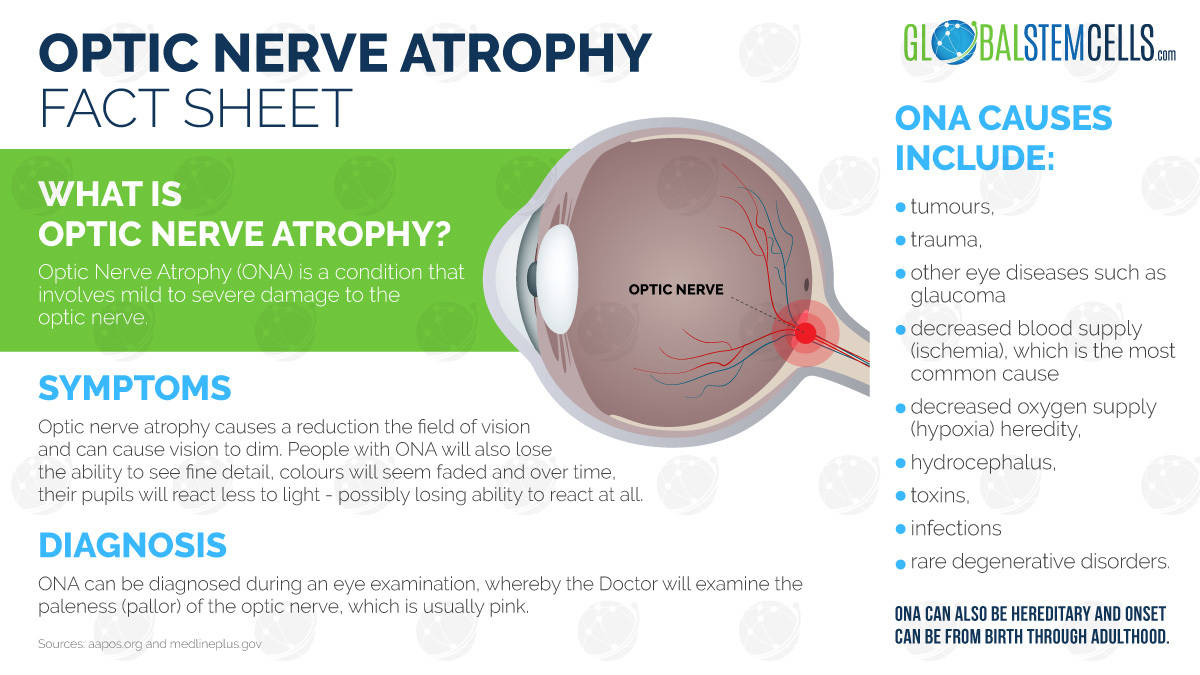 Optic Nerve Atrophy Infographic