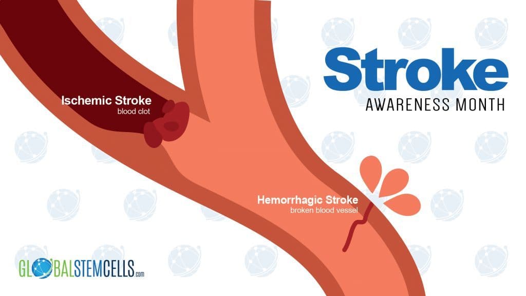 Stroke Awareness Month 2017