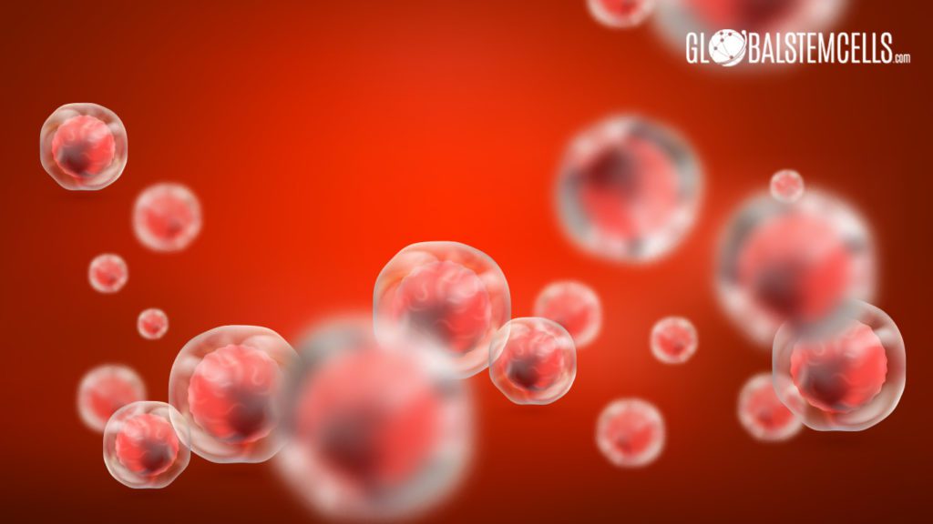 Breakthrough Stem Cell Treatment For Patients With MS - Global Stem Cells